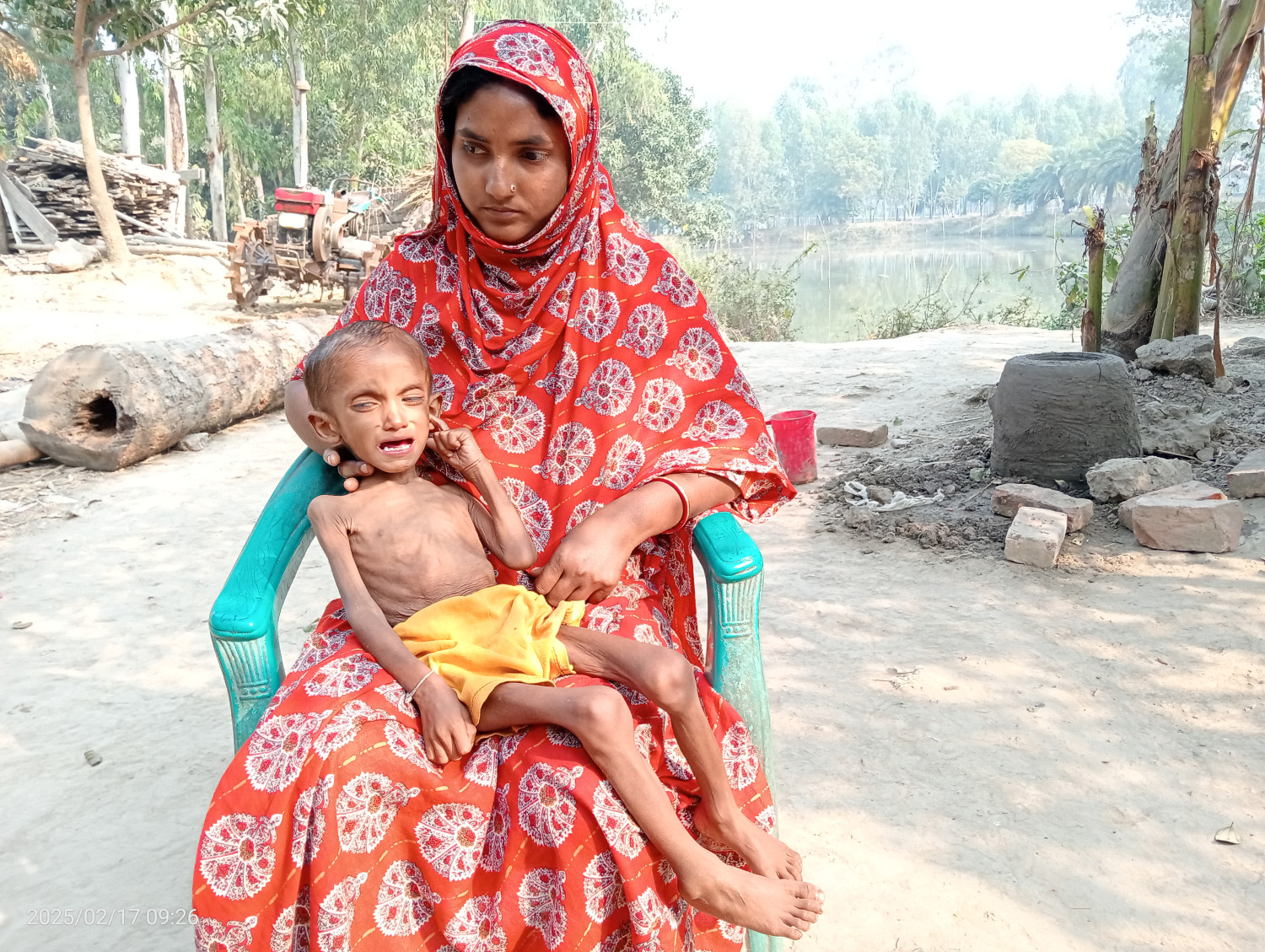 অর্থাভাবে মিলছে না উন্নত চিকিৎসা শুকিয়ে কঙ্কালসার শিশু আবু তালহা